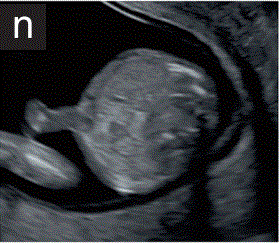 胎儿mt是什么检查什么疼吗【文献学习／规范指南】ISUOG实践指南（2023更新）： 11-14周胎儿超声检查（全文）_https://www.jmylbn.com_新闻资讯_第24张