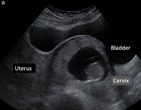 胎儿mt是什么检查什么疼吗【文献学习／规范指南】ISUOG实践指南（2023更新）： 11-14周胎儿超声检查（全文）_https://www.jmylbn.com_新闻资讯_第33张