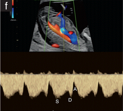 胎儿mt是什么检查什么疼吗【文献学习／规范指南】ISUOG实践指南（2023更新）： 11-14周胎儿超声检查（全文）_https://www.jmylbn.com_新闻资讯_第31张