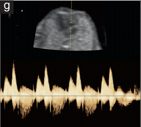 胎儿mt是什么检查什么疼吗【文献学习／规范指南】ISUOG实践指南（2023更新）： 11-14周胎儿超声检查（全文）_https://www.jmylbn.com_新闻资讯_第32张