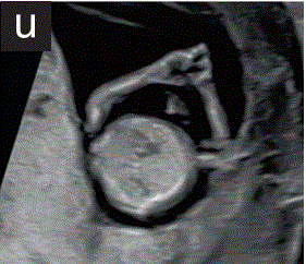 胎儿mt是什么检查什么疼吗【文献学习／规范指南】ISUOG实践指南（2023更新）： 11-14周胎儿超声检查（全文）_https://www.jmylbn.com_新闻资讯_第28张