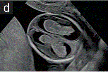 胎儿mt是什么检查什么疼吗【文献学习／规范指南】ISUOG实践指南（2023更新）： 11-14周胎儿超声检查（全文）_https://www.jmylbn.com_新闻资讯_第9张