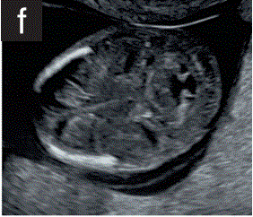 胎儿mt是什么检查什么疼吗【文献学习／规范指南】ISUOG实践指南（2023更新）： 11-14周胎儿超声检查（全文）_https://www.jmylbn.com_新闻资讯_第11张