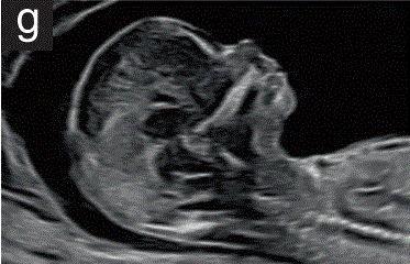 胎儿mt是什么检查什么疼吗【文献学习／规范指南】ISUOG实践指南（2023更新）： 11-14周胎儿超声检查（全文）_https://www.jmylbn.com_新闻资讯_第12张