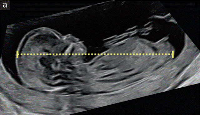 胎儿mt是什么检查什么疼吗【文献学习／规范指南】ISUOG实践指南（2023更新）： 11-14周胎儿超声检查（全文）_https://www.jmylbn.com_新闻资讯_第2张