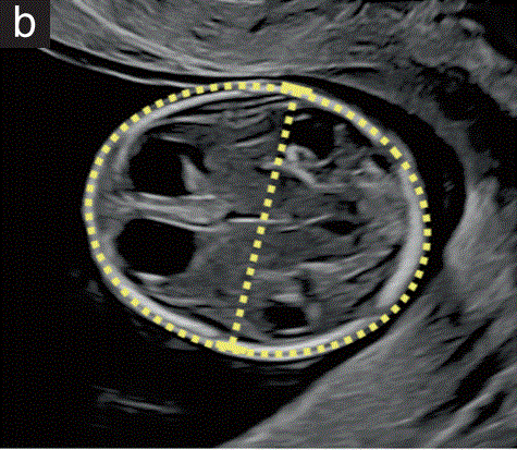 胎儿mt是什么检查什么疼吗【文献学习／规范指南】ISUOG实践指南（2023更新）： 11-14周胎儿超声检查（全文）_https://www.jmylbn.com_新闻资讯_第3张