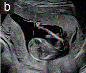 胎儿mt是什么检查什么疼吗【文献学习／规范指南】ISUOG实践指南（2023更新）： 11-14周胎儿超声检查（全文）_https://www.jmylbn.com_新闻资讯_第7张