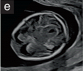 胎儿mt是什么检查什么疼吗【文献学习／规范指南】ISUOG实践指南（2023更新）： 11-14周胎儿超声检查（全文）_https://www.jmylbn.com_新闻资讯_第10张