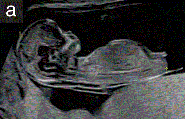 胎儿mt是什么检查什么疼吗【文献学习／规范指南】ISUOG实践指南（2023更新）： 11-14周胎儿超声检查（全文）_https://www.jmylbn.com_新闻资讯_第6张