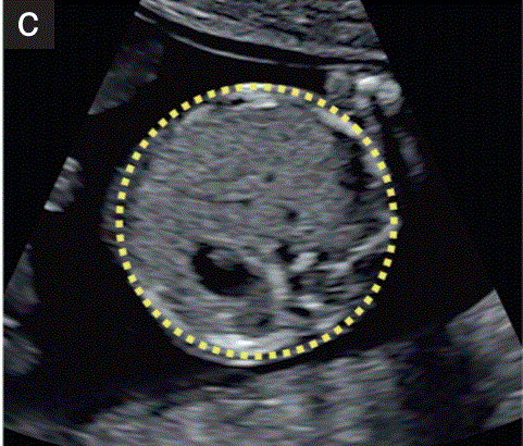 胎儿mt是什么检查什么疼吗【文献学习／规范指南】ISUOG实践指南（2023更新）： 11-14周胎儿超声检查（全文）_https://www.jmylbn.com_新闻资讯_第4张