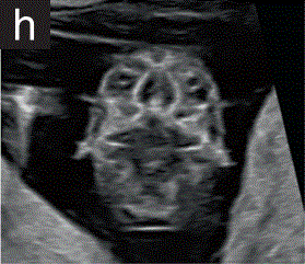 胎儿mt是什么检查什么疼吗【文献学习／规范指南】ISUOG实践指南（2023更新）： 11-14周胎儿超声检查（全文）_https://www.jmylbn.com_新闻资讯_第14张