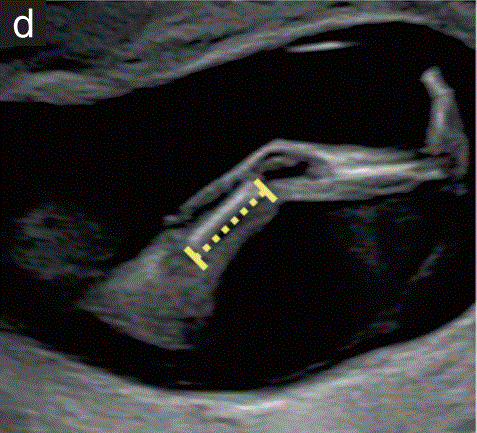 胎儿mt是什么检查什么疼吗【文献学习／规范指南】ISUOG实践指南（2023更新）： 11-14周胎儿超声检查（全文）_https://www.jmylbn.com_新闻资讯_第5张