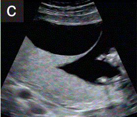 胎儿mt是什么检查什么疼吗【文献学习／规范指南】ISUOG实践指南（2023更新）： 11-14周胎儿超声检查（全文）_https://www.jmylbn.com_新闻资讯_第8张