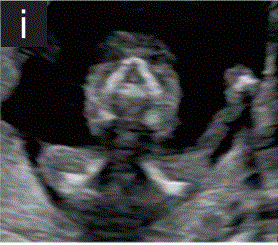 胎儿mt是什么检查什么疼吗【文献学习／规范指南】ISUOG实践指南（2023更新）： 11-14周胎儿超声检查（全文）_https://www.jmylbn.com_新闻资讯_第15张