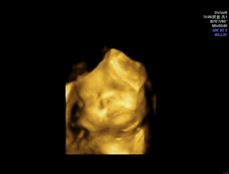 汕头彩超怎么样孕期四维彩超能看懂这几点，胎儿的小秘密就“没了”『汕头妇科医院』_https://www.jmylbn.com_新闻资讯_第7张