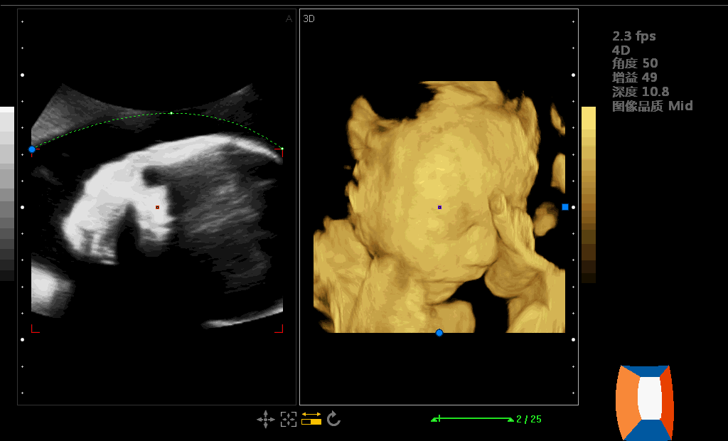 汕头彩超怎么样孕期四维彩超能看懂这几点，胎儿的小秘密就“没了”『汕头妇科医院』_https://www.jmylbn.com_新闻资讯_第6张
