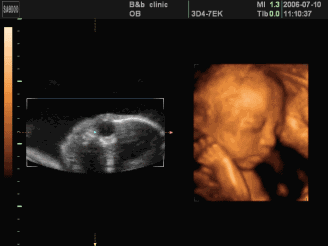 汕头彩超怎么样孕期四维彩超能看懂这几点，胎儿的小秘密就“没了”『汕头妇科医院』_https://www.jmylbn.com_新闻资讯_第9张