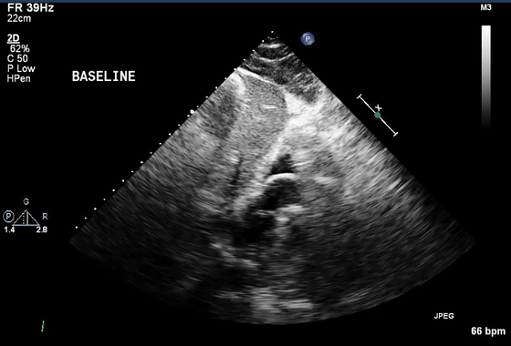 彩超伪像是什么心脏超声伪像有哪些？如何识别它们？_https://www.jmylbn.com_新闻资讯_第16张