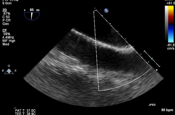 彩超伪像是什么心脏超声伪像有哪些？如何识别它们？_https://www.jmylbn.com_新闻资讯_第38张