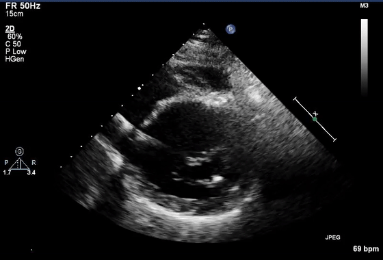 彩超伪像是什么心脏超声伪像有哪些？如何识别它们？_https://www.jmylbn.com_新闻资讯_第29张