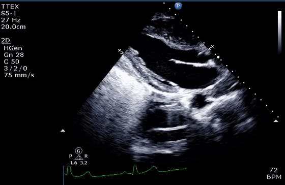 彩超伪像是什么心脏超声伪像有哪些？如何识别它们？_https://www.jmylbn.com_新闻资讯_第12张