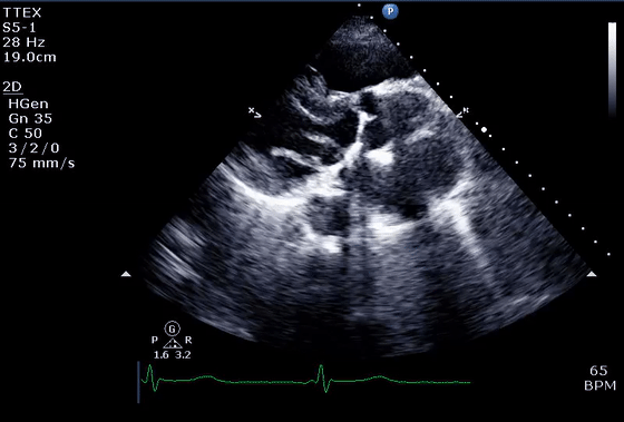 彩超伪像是什么心脏超声伪像有哪些？如何识别它们？_https://www.jmylbn.com_新闻资讯_第8张