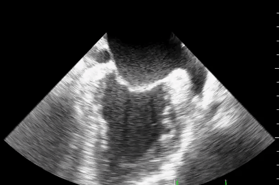 彩超伪像是什么心脏超声伪像有哪些？如何识别它们？_https://www.jmylbn.com_新闻资讯_第36张