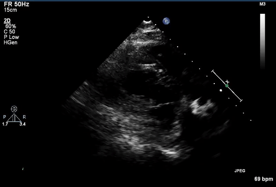 彩超伪像是什么心脏超声伪像有哪些？如何识别它们？_https://www.jmylbn.com_新闻资讯_第33张