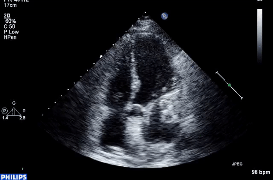 彩超伪像是什么心脏超声伪像有哪些？如何识别它们？_https://www.jmylbn.com_新闻资讯_第32张