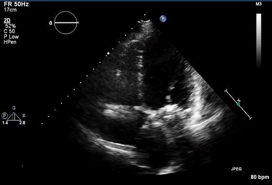 彩超伪像是什么心脏超声伪像有哪些？如何识别它们？_https://www.jmylbn.com_新闻资讯_第28张