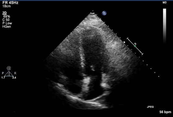 彩超伪像是什么心脏超声伪像有哪些？如何识别它们？_https://www.jmylbn.com_新闻资讯_第25张