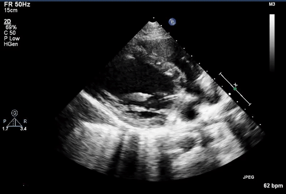 彩超伪像是什么心脏超声伪像有哪些？如何识别它们？_https://www.jmylbn.com_新闻资讯_第20张