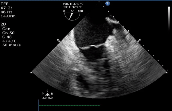 彩超伪像是什么心脏超声伪像有哪些？如何识别它们？_https://www.jmylbn.com_新闻资讯_第39张