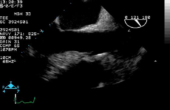 彩超伪像是什么心脏超声伪像有哪些？如何识别它们？_https://www.jmylbn.com_新闻资讯_第41张