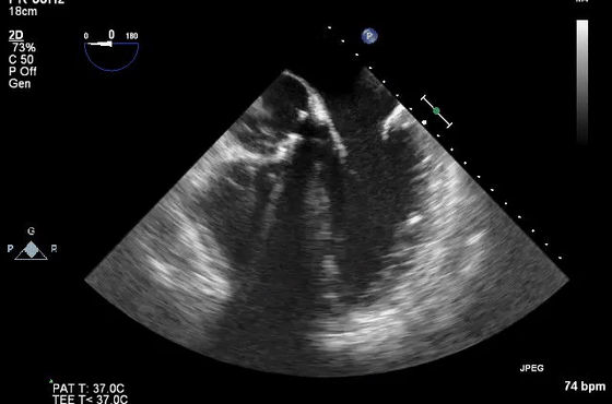彩超伪像是什么心脏超声伪像有哪些？如何识别它们？_https://www.jmylbn.com_新闻资讯_第37张