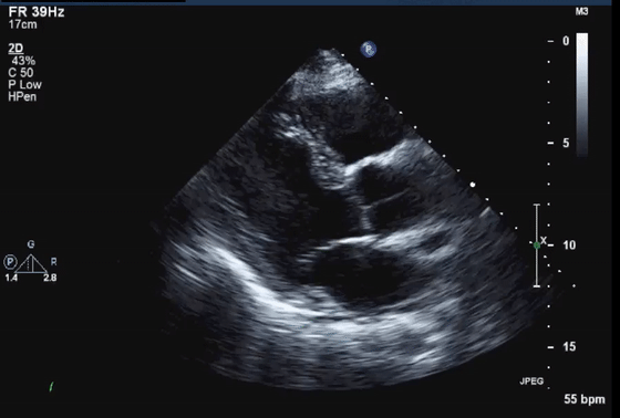 彩超伪像是什么心脏超声伪像有哪些？如何识别它们？_https://www.jmylbn.com_新闻资讯_第7张