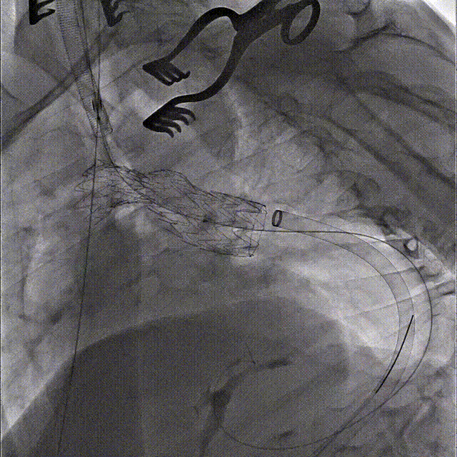 gore医疗怎么样「胸有乾坤」国际首例 微创杂交技术治疗巨大左锁骨下动脉瘤合并主动脉缩窄Larsen综合症患者_https://www.jmylbn.com_新闻资讯_第11张