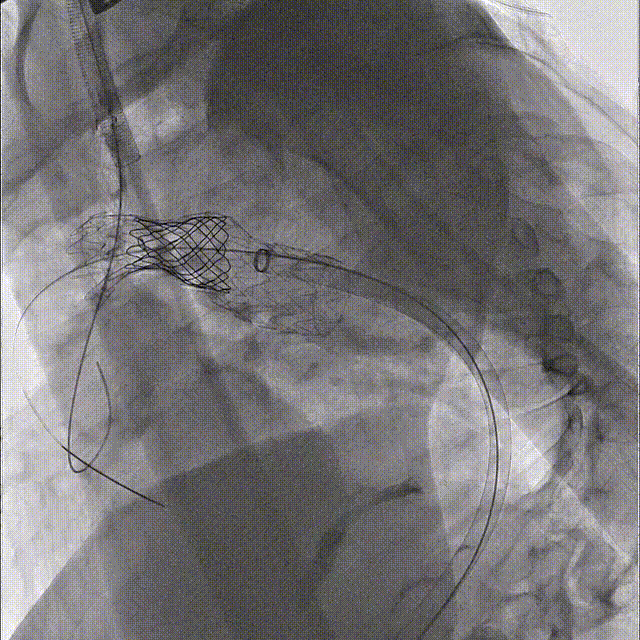 gore医疗怎么样「胸有乾坤」国际首例 微创杂交技术治疗巨大左锁骨下动脉瘤合并主动脉缩窄Larsen综合症患者_https://www.jmylbn.com_新闻资讯_第13张