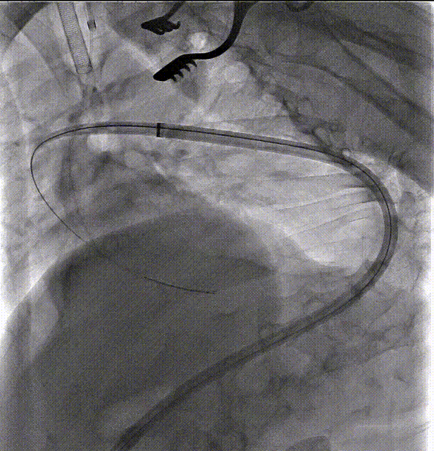 gore医疗怎么样「胸有乾坤」国际首例 微创杂交技术治疗巨大左锁骨下动脉瘤合并主动脉缩窄Larsen综合症患者_https://www.jmylbn.com_新闻资讯_第9张