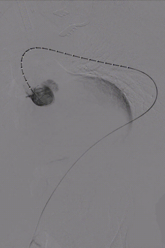 gore医疗怎么样「胸有乾坤」国际首例 微创杂交技术治疗巨大左锁骨下动脉瘤合并主动脉缩窄Larsen综合症患者_https://www.jmylbn.com_新闻资讯_第8张