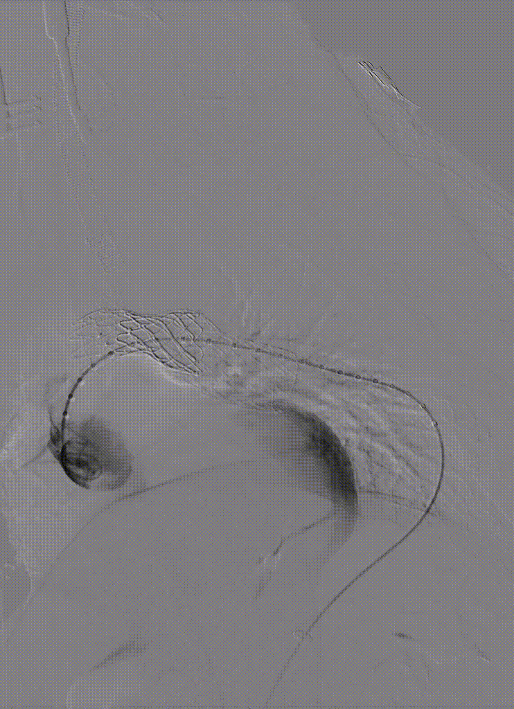 gore医疗怎么样「胸有乾坤」国际首例 微创杂交技术治疗巨大左锁骨下动脉瘤合并主动脉缩窄Larsen综合症患者_https://www.jmylbn.com_新闻资讯_第14张