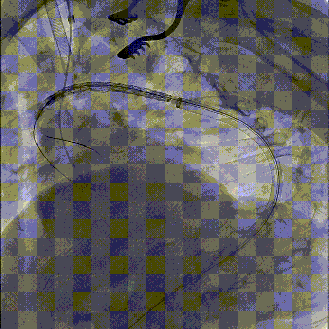 gore医疗怎么样「胸有乾坤」国际首例 微创杂交技术治疗巨大左锁骨下动脉瘤合并主动脉缩窄Larsen综合症患者_https://www.jmylbn.com_新闻资讯_第10张