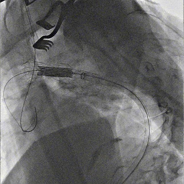 gore医疗怎么样「胸有乾坤」国际首例 微创杂交技术治疗巨大左锁骨下动脉瘤合并主动脉缩窄Larsen综合症患者_https://www.jmylbn.com_新闻资讯_第12张
