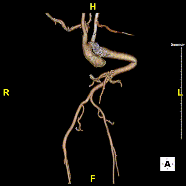 gore医疗怎么样「胸有乾坤」国际首例 微创杂交技术治疗巨大左锁骨下动脉瘤合并主动脉缩窄Larsen综合症患者_https://www.jmylbn.com_新闻资讯_第15张