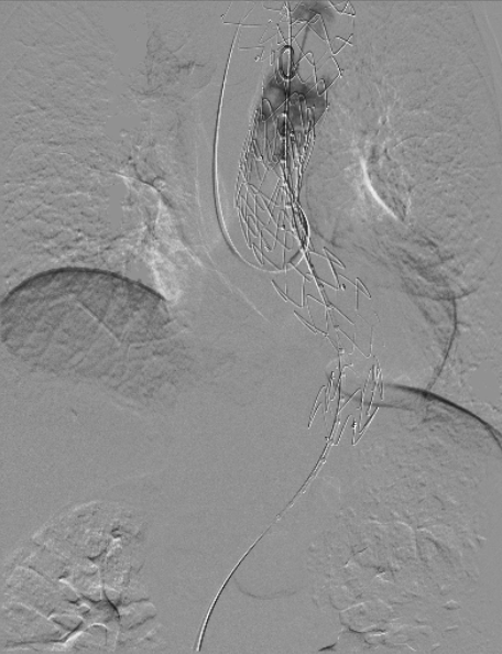 治疗车怎么推「弓部重建直通车」鄂尔多斯市中心医院康巴什部介入科运用Castor®分支型支架联合预开窗技术治疗Stanford B型胸主动夹层_https://www.jmylbn.com_新闻资讯_第11张