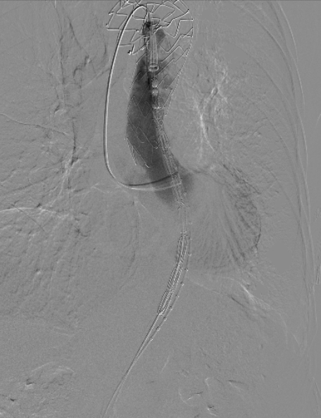 治疗车怎么推「弓部重建直通车」鄂尔多斯市中心医院康巴什部介入科运用Castor®分支型支架联合预开窗技术治疗Stanford B型胸主动夹层_https://www.jmylbn.com_新闻资讯_第10张