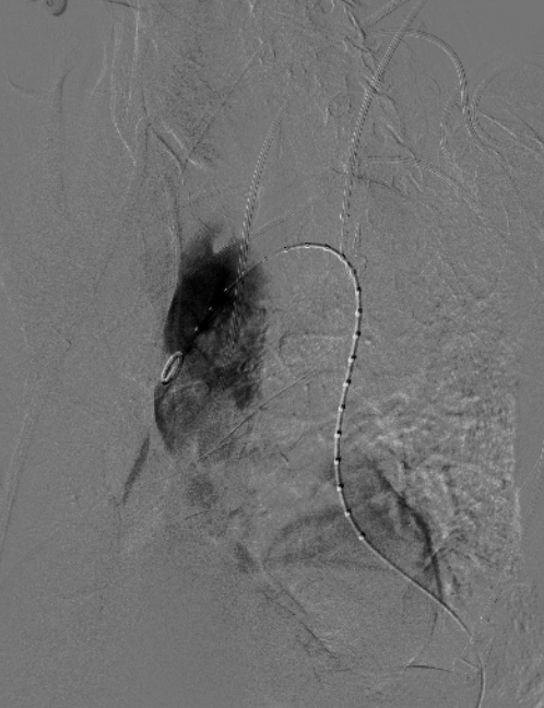 治疗车怎么推「弓部重建直通车」鄂尔多斯市中心医院康巴什部介入科运用Castor®分支型支架联合预开窗技术治疗Stanford B型胸主动夹层_https://www.jmylbn.com_新闻资讯_第6张