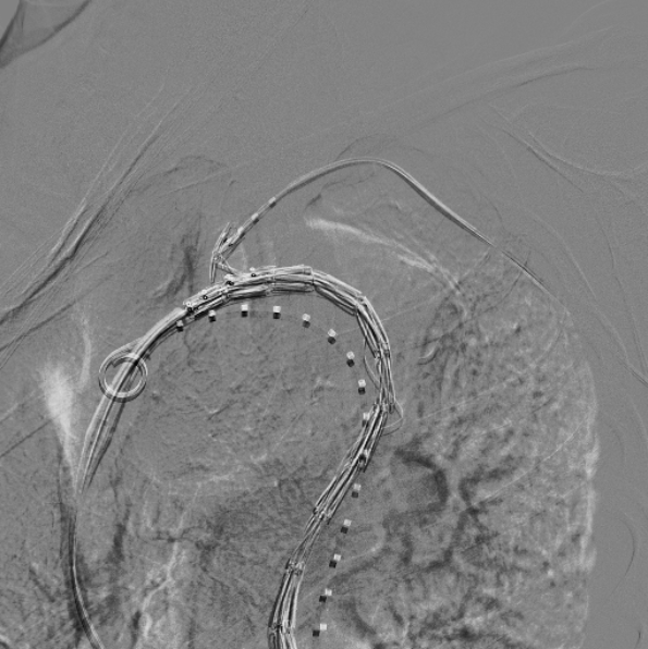 治疗车怎么推「弓部重建直通车」鄂尔多斯市中心医院康巴什部介入科运用Castor®分支型支架联合预开窗技术治疗Stanford B型胸主动夹层_https://www.jmylbn.com_新闻资讯_第8张