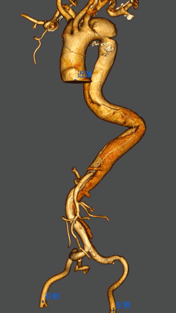 治疗车怎么推「弓部重建直通车」鄂尔多斯市中心医院康巴什部介入科运用Castor®分支型支架联合预开窗技术治疗Stanford B型胸主动夹层_https://www.jmylbn.com_新闻资讯_第3张