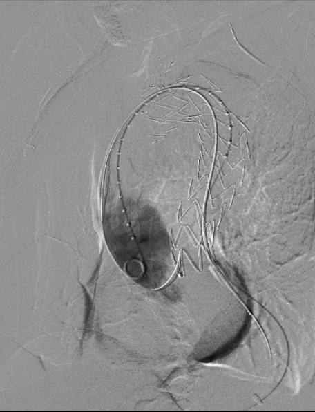 治疗车怎么推「弓部重建直通车」鄂尔多斯市中心医院康巴什部介入科运用Castor®分支型支架联合预开窗技术治疗Stanford B型胸主动夹层_https://www.jmylbn.com_新闻资讯_第9张